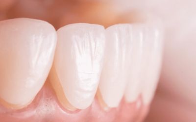 Як довго тримаються вініри на зубах?
