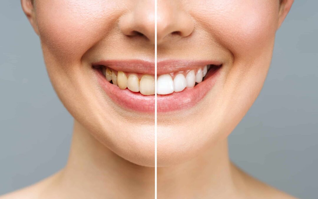 Поширені міфи про відбілювання зубів